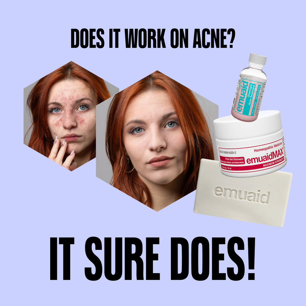 EMUAID Trío Borrador del Acné EMUAID Trío Borrador del Acné