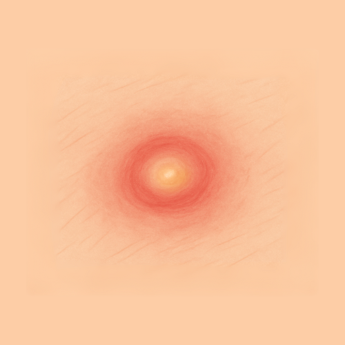 Imagen dibujada de un forúnculo