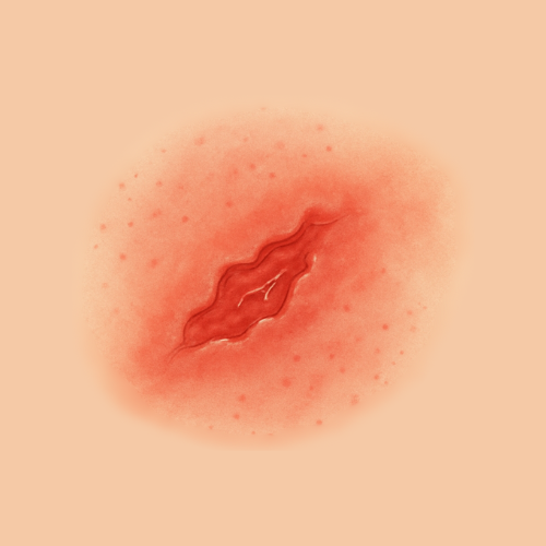 Imagen dibujada de una herida