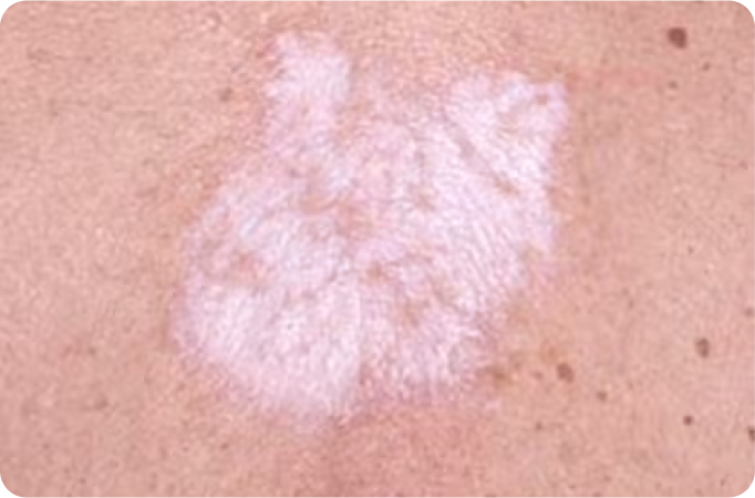 ¿Sufre de liquen escleroso?