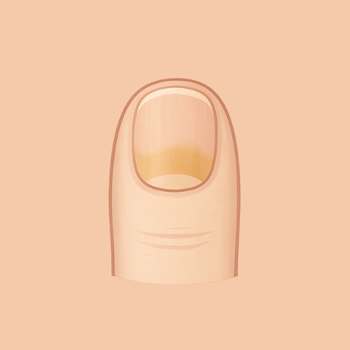 Imagen dibujada de hongos en las uñas