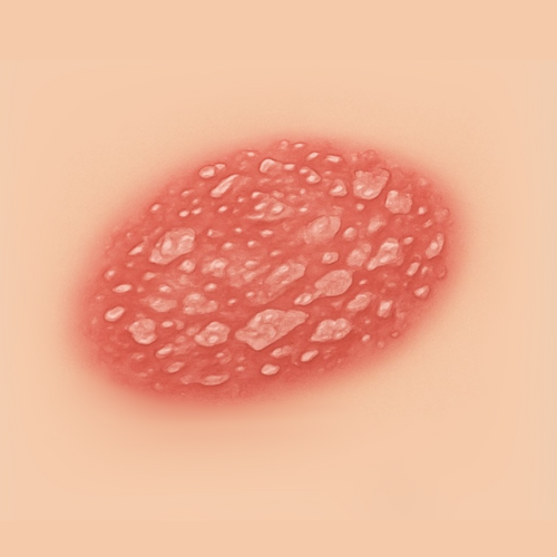 Imagen dibujada de una psoriasis