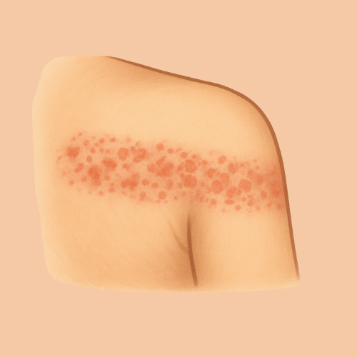 Imagen dibujada de una erupción en el hombro