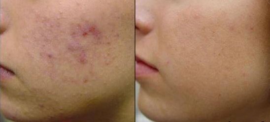 EMUAID Tratamiento de noche para el acné 1oz EMUAID Tratamiento de noche para el acné 1oz