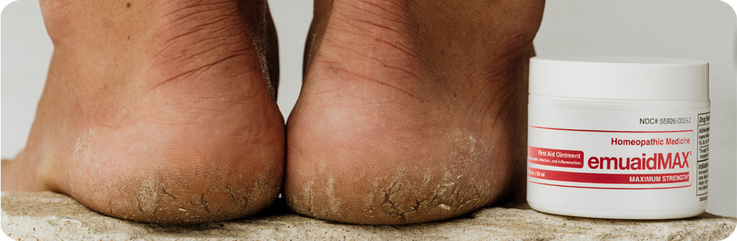 EMUAID los patógenos y elimina las verrugas plantares y palmares sin congelar ni quemar*.