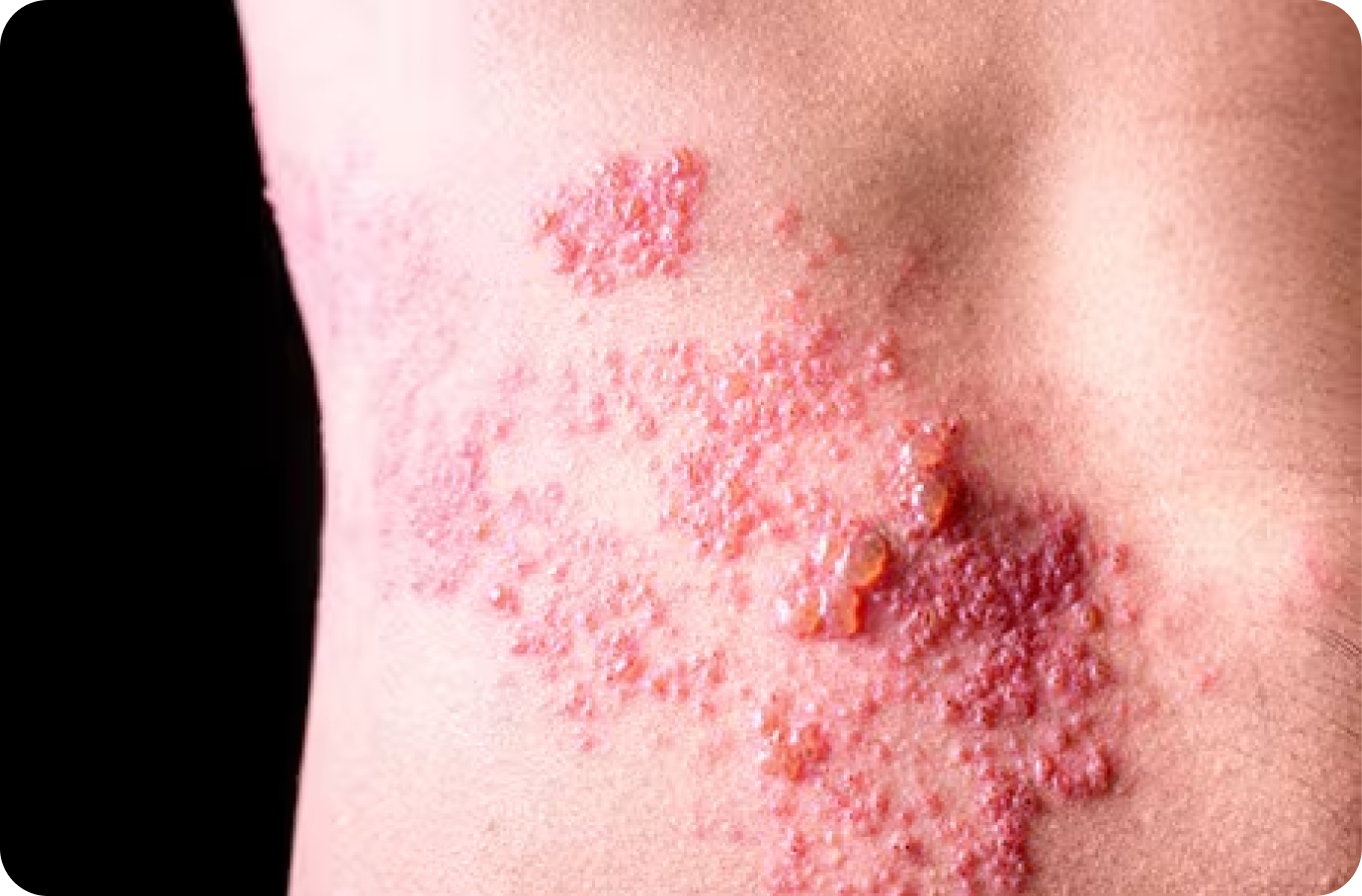 ¿Sufre de herpes zóster?
