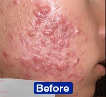 Resultados de estudios clínicos