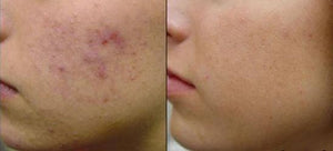 EMUAID Dúo Borrador de Acné