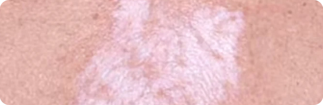 ¿Sufre de liquen escleroso?
