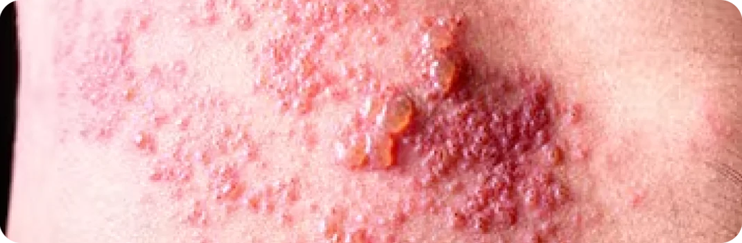 ¿Sufre de herpes zóster?
